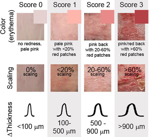 Psoriasis Area Severity Index (PASI) scoring